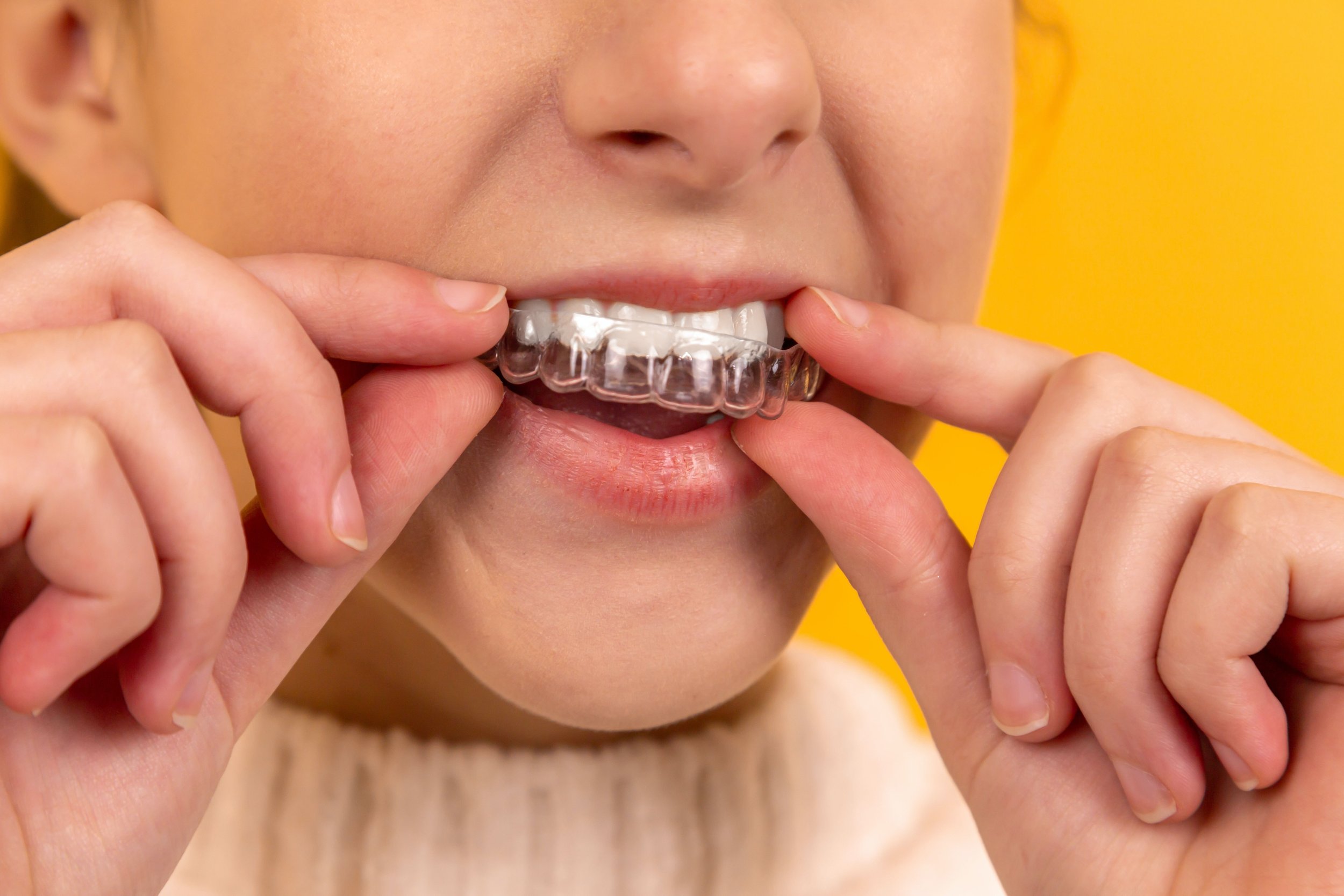 Invisalign Braces: Clear Aligners. Teeth Straightening. Invisible Braces.