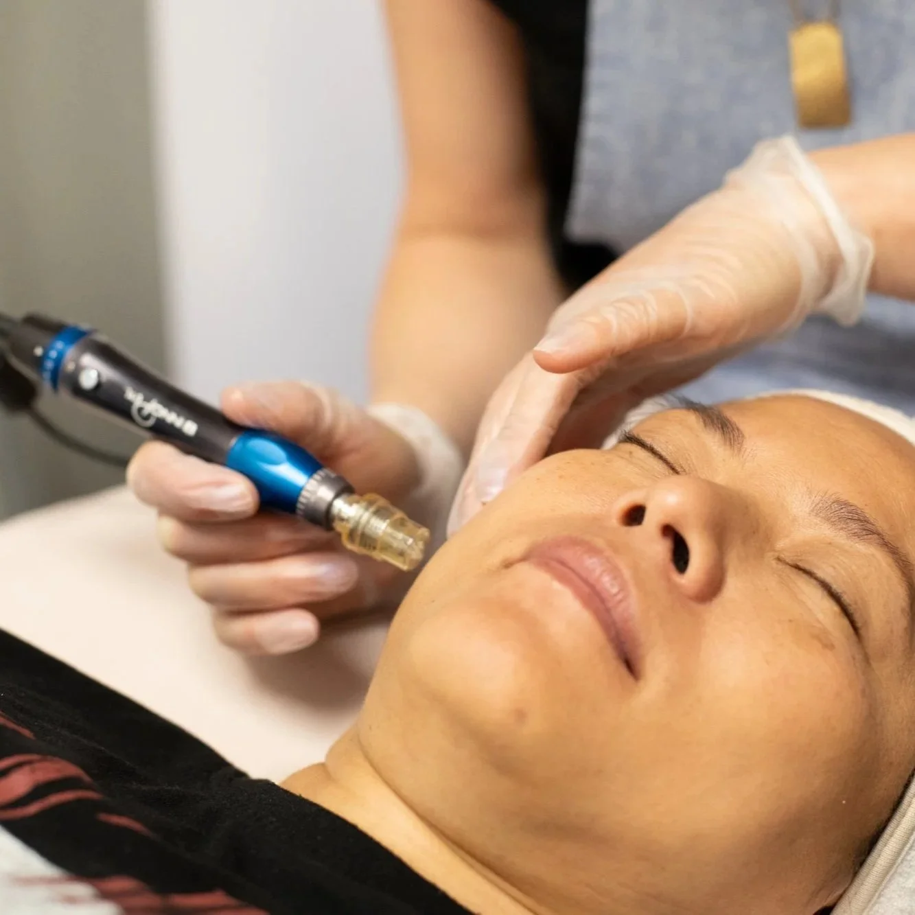 MICRONEEDLING