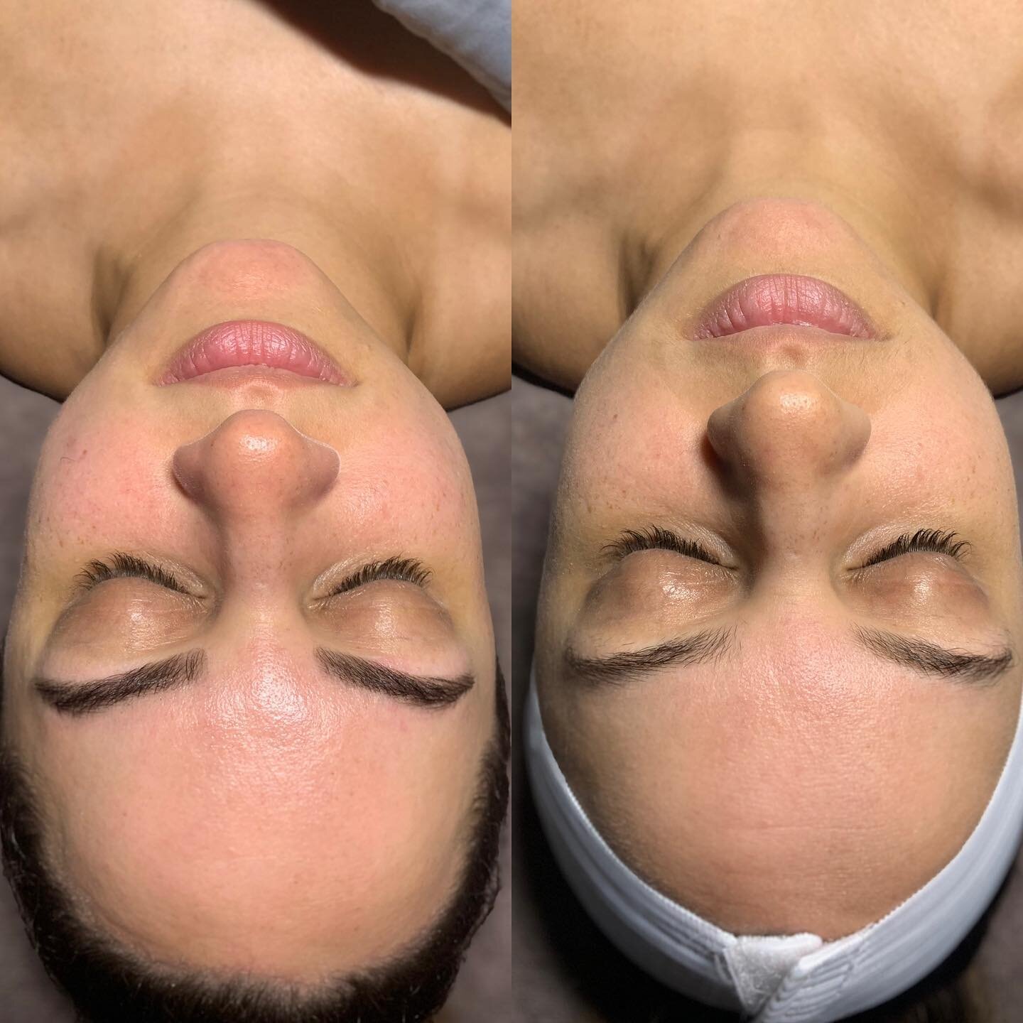 No Filter Needed 😉 

Before (right) &amp; after (left) of my client who received the Hydroglow + Dermaplaning facial and brow threading + tint. 

This facial is the perfect treatment after vacation when your skin needs that extra somethin&rsquo;! 
#