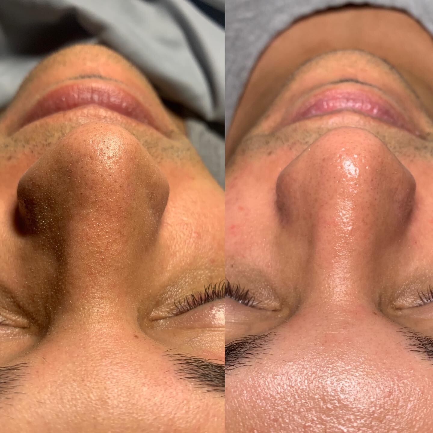 NEW SERVICE ALERT🚨 

HydroGlow Facial is now available for online booking! 

This facial includes hydrodermabrasion -water, serums and suction for a deep cleanse, exfoliation and extractions, radio frequency therapy - a warming technology that helps