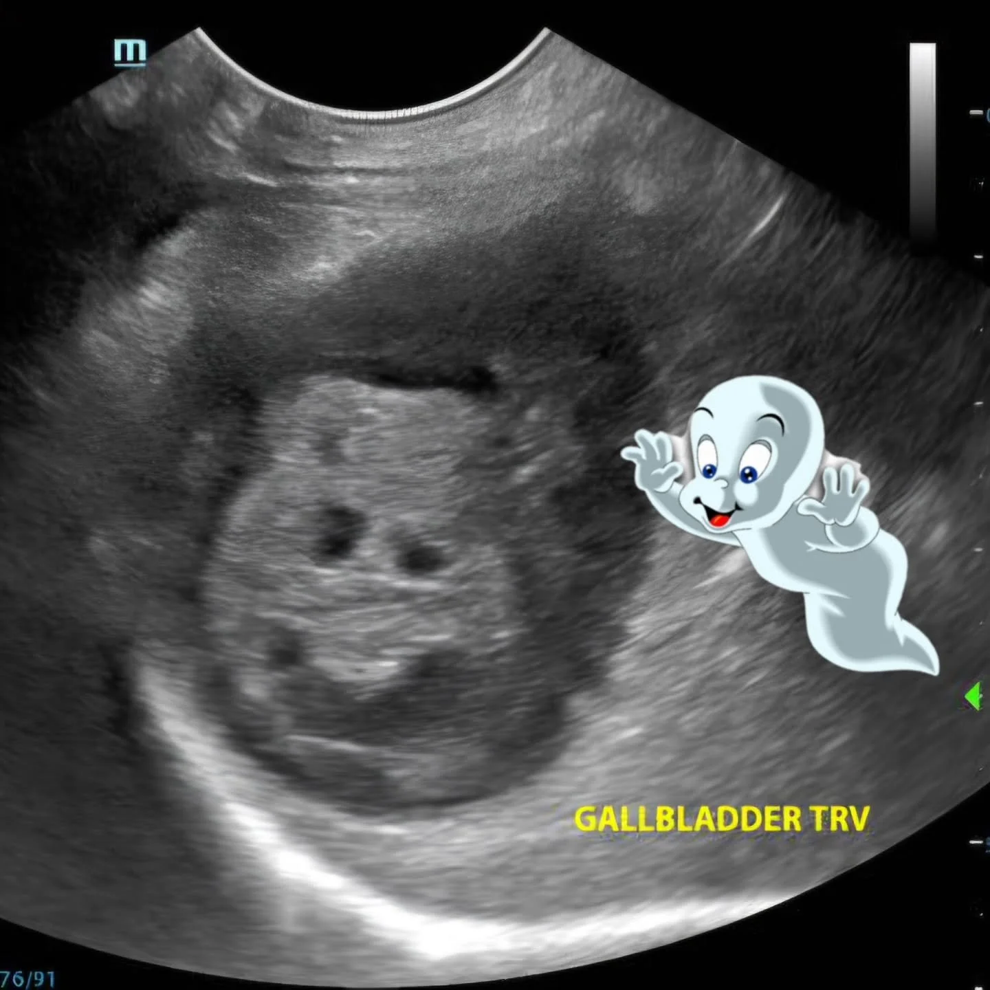 🎃 Happy Halloween from FUR!
...

Even gallbladders and cribiform plates can be spooky! 
...

Do you ever come across images that look like something else? 

#halloween #radiology #veterinaryultrasound