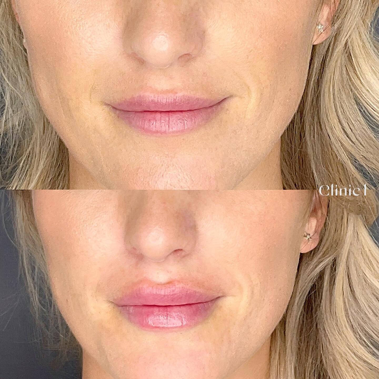 Lip filler by Tessa (0.5ml) 🔥 We have very limited appointments left for 20% off with Tessa in April, jump online 😻

#clinic1_tessa#clinic1nz#ponsonby#russianlipsnz