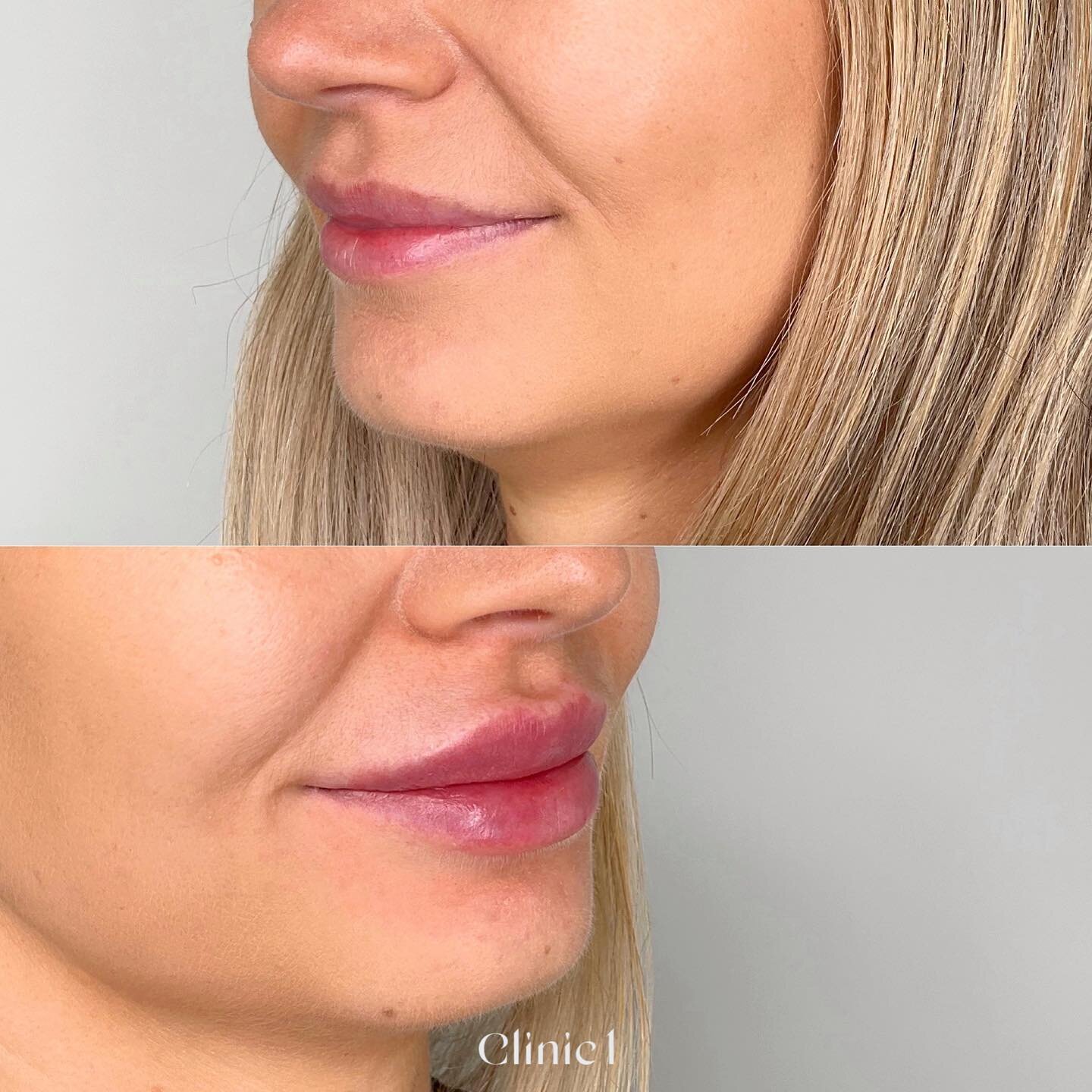 1ml of lip filler by Tessa 🔥$520 till the end of April (normal price $650). Book online xx

#clinic1_tessa