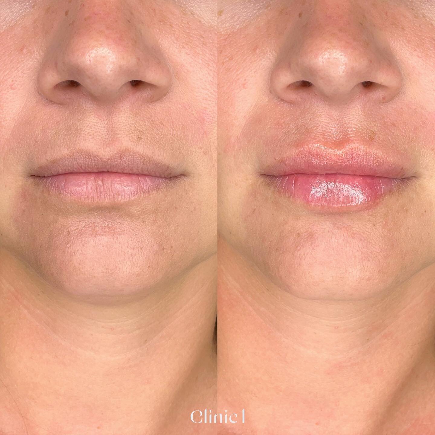 Delicate and natural, lip filler by Tessa 😻 $360 for 0.5ml, $520 for 1ml only till the end of April and only with Tessa. Book online xx 

#lipfillerauckland#clinic1_tessa#ponsonby