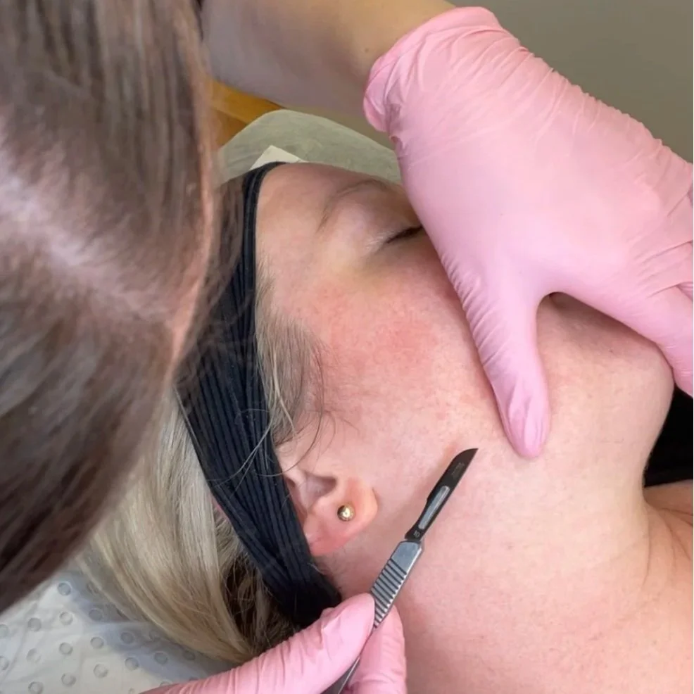 Dermaplaning with a surgical blade across a client's cheek