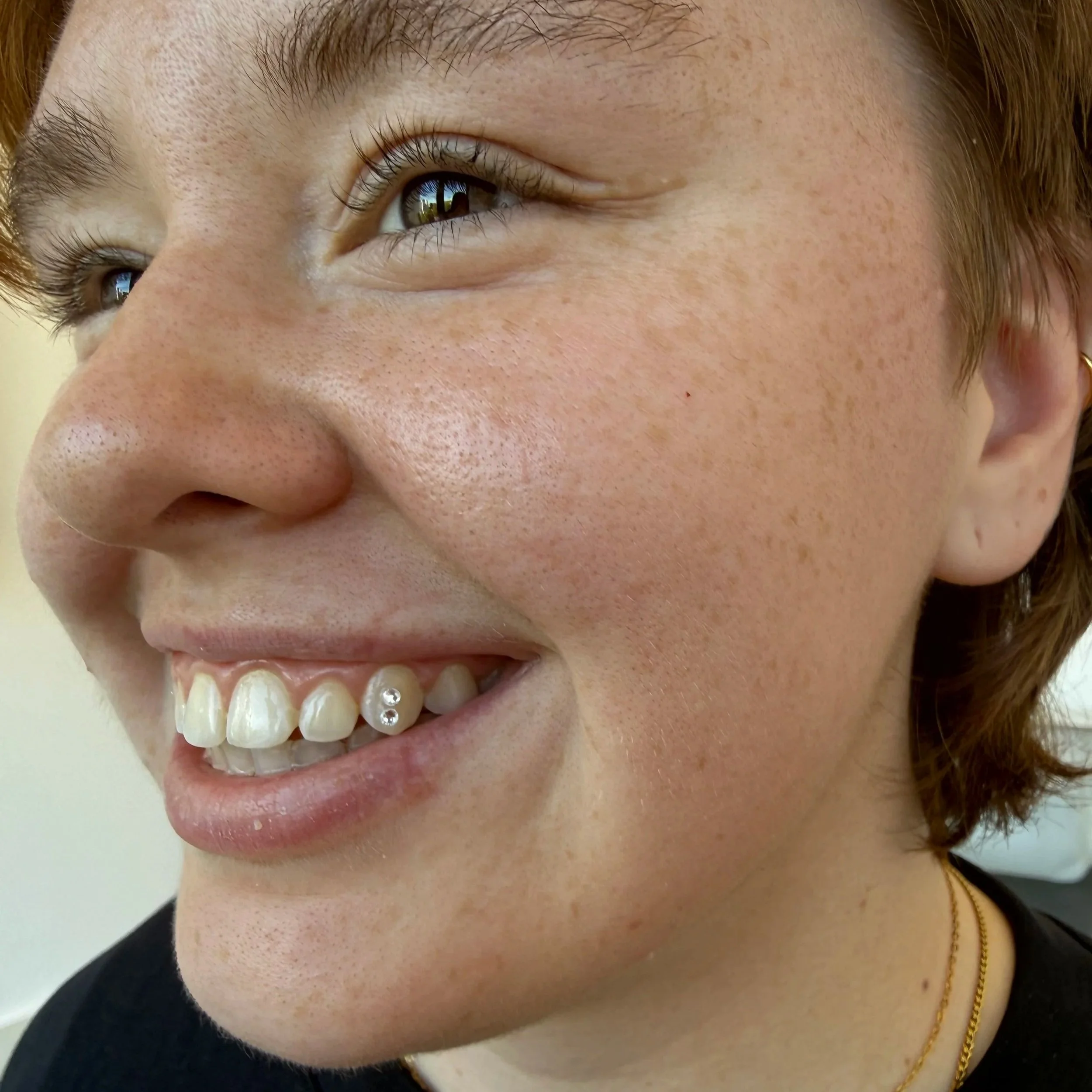 Crystal tooth gem applied to a client's front tooth