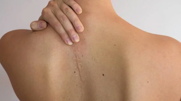 Person with a scar on their upper back, touching their shoulder with their hand.