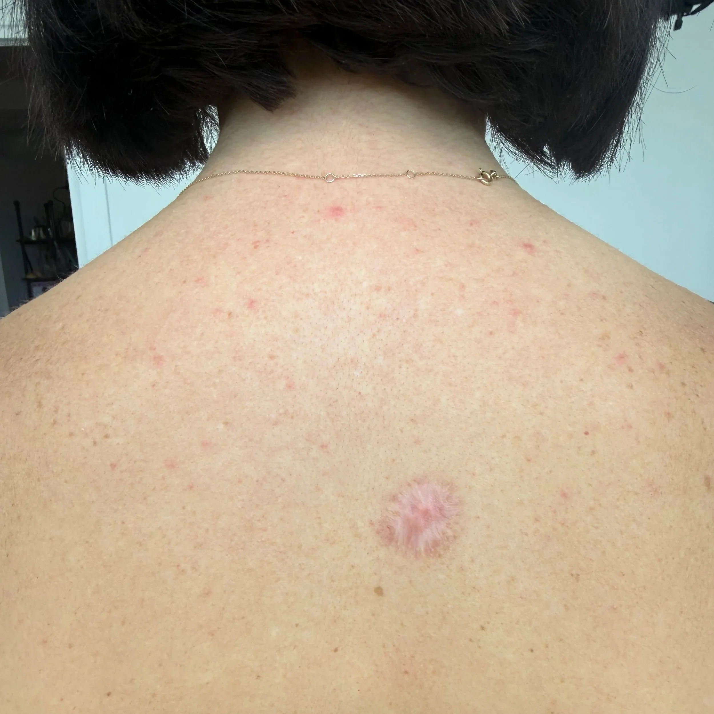 Microneedling scar revision treatment on a client's Back