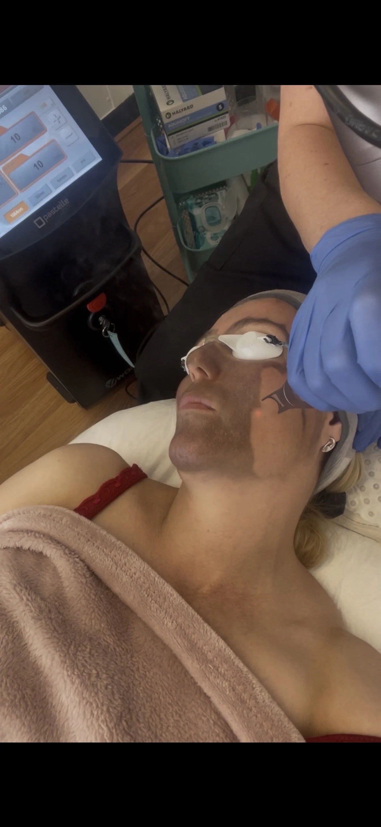 Client receiving a carbon laser peel at Neev Skincare and Laser in Hackney