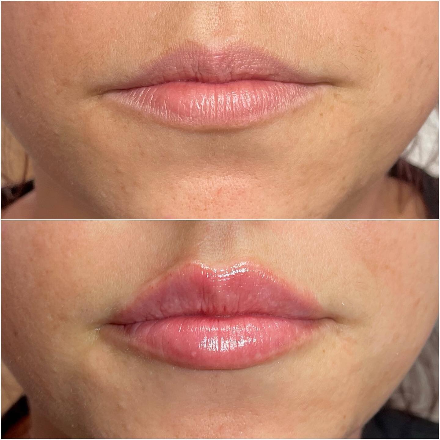 How gorgeous are these lippies? 👄 
#AOSbabe🤍
.
.
.
#lips #lippies #lipfiller #dermalfiller #fillers #beforeandafter #transformation #results #natural #flawless #toronto #windsor #leaside #cosmetics #aesthetics #beauty