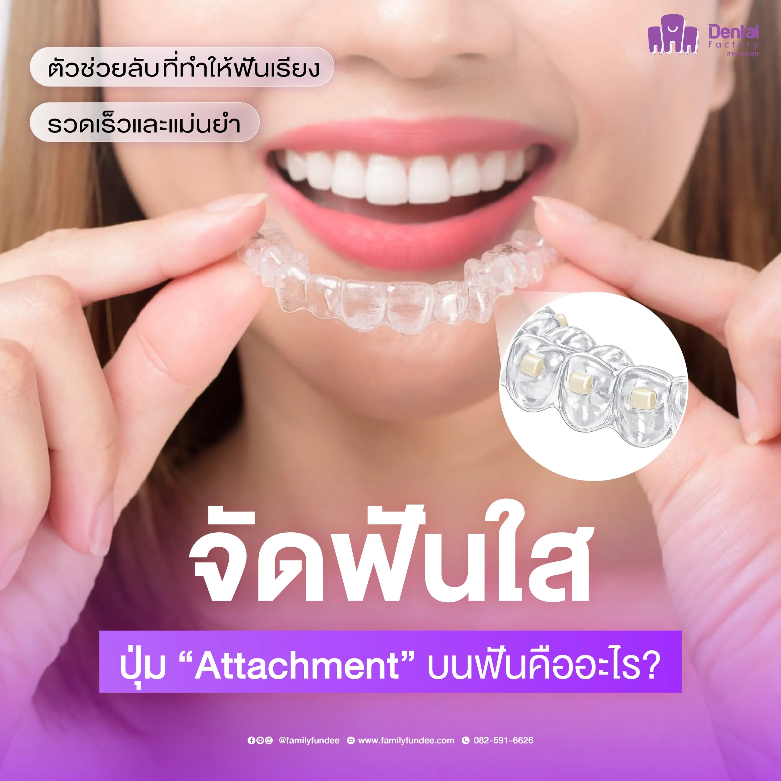 จัดฟันใส "ปุ่ม Attachment" บนฟันคืออะไร? ตัวช่วยลับที่ทำให้ฟันเรียงรวดเร็วและแม่นยำ | จัดฟันใส อุดมสุข