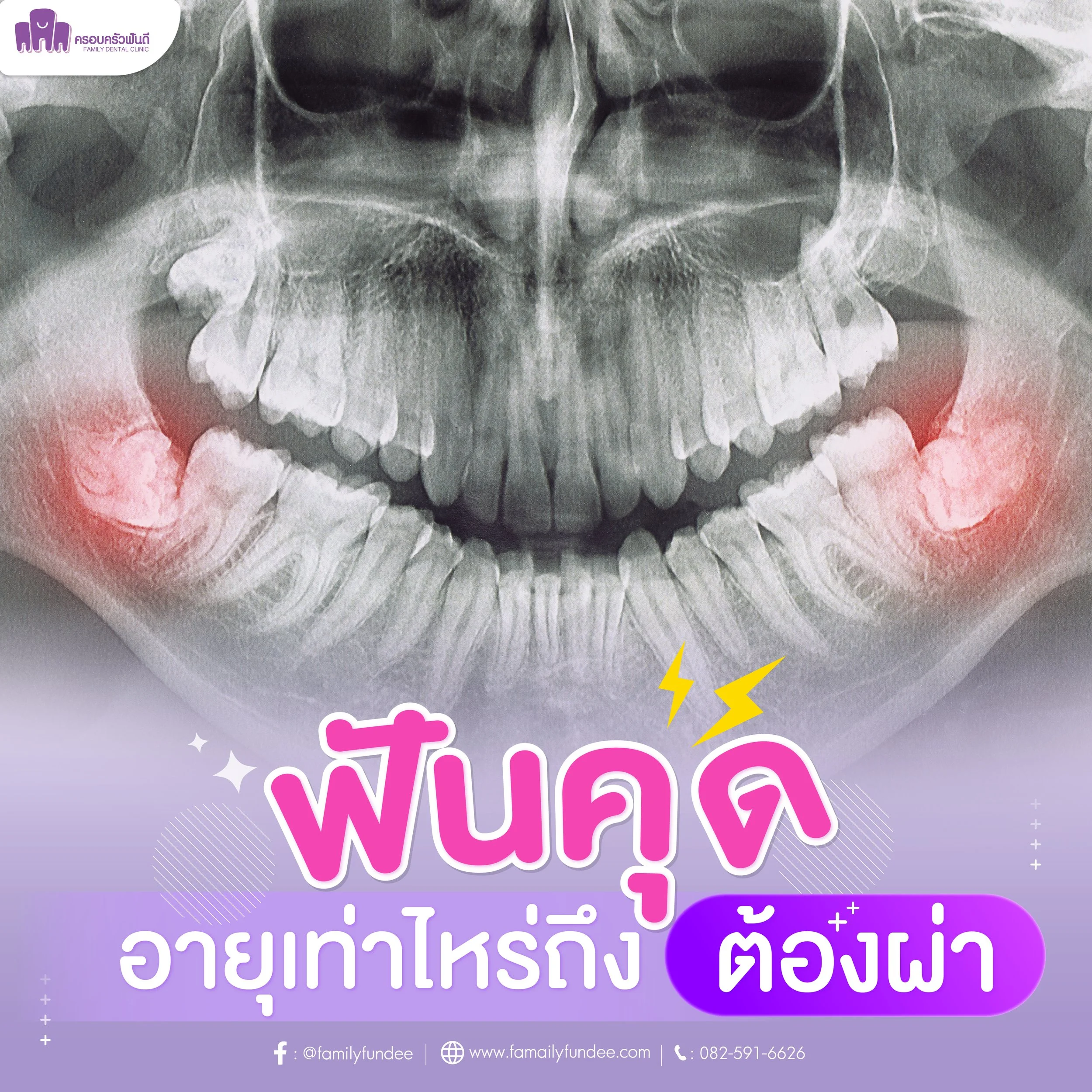 ฟันคุด | อายุเท่าไหร่ถึงต้องผ่า — Family Dental Clinic