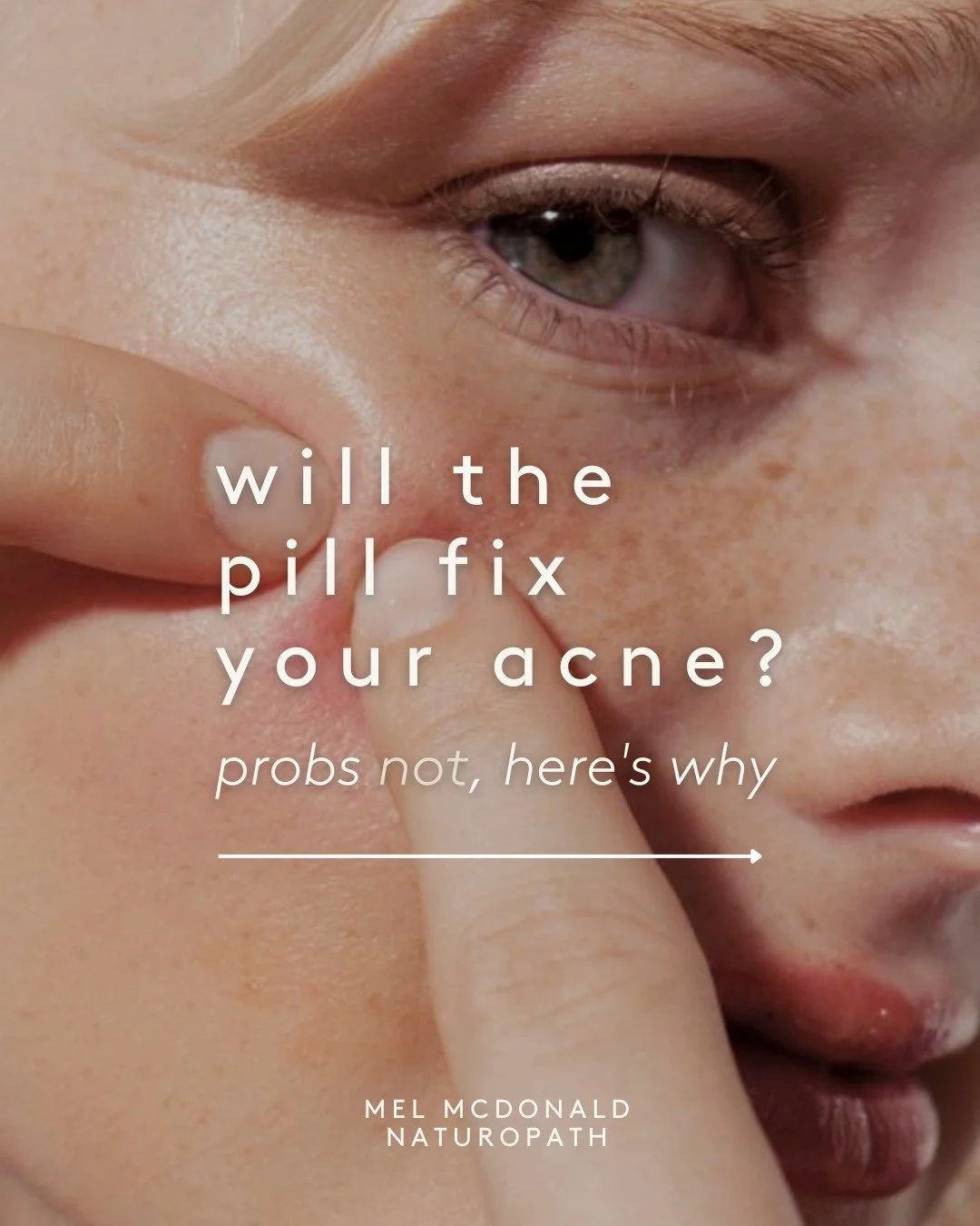 Will the Pill Fix Your Acne? Probs not. Here&rsquo;s why:

👉 The pill is like a bandaid. It may help to cover up your acne temporarily, but it doesn't address the root cause of the problem.

👉 The pill &lsquo;tricks&rsquo; your body into functionin