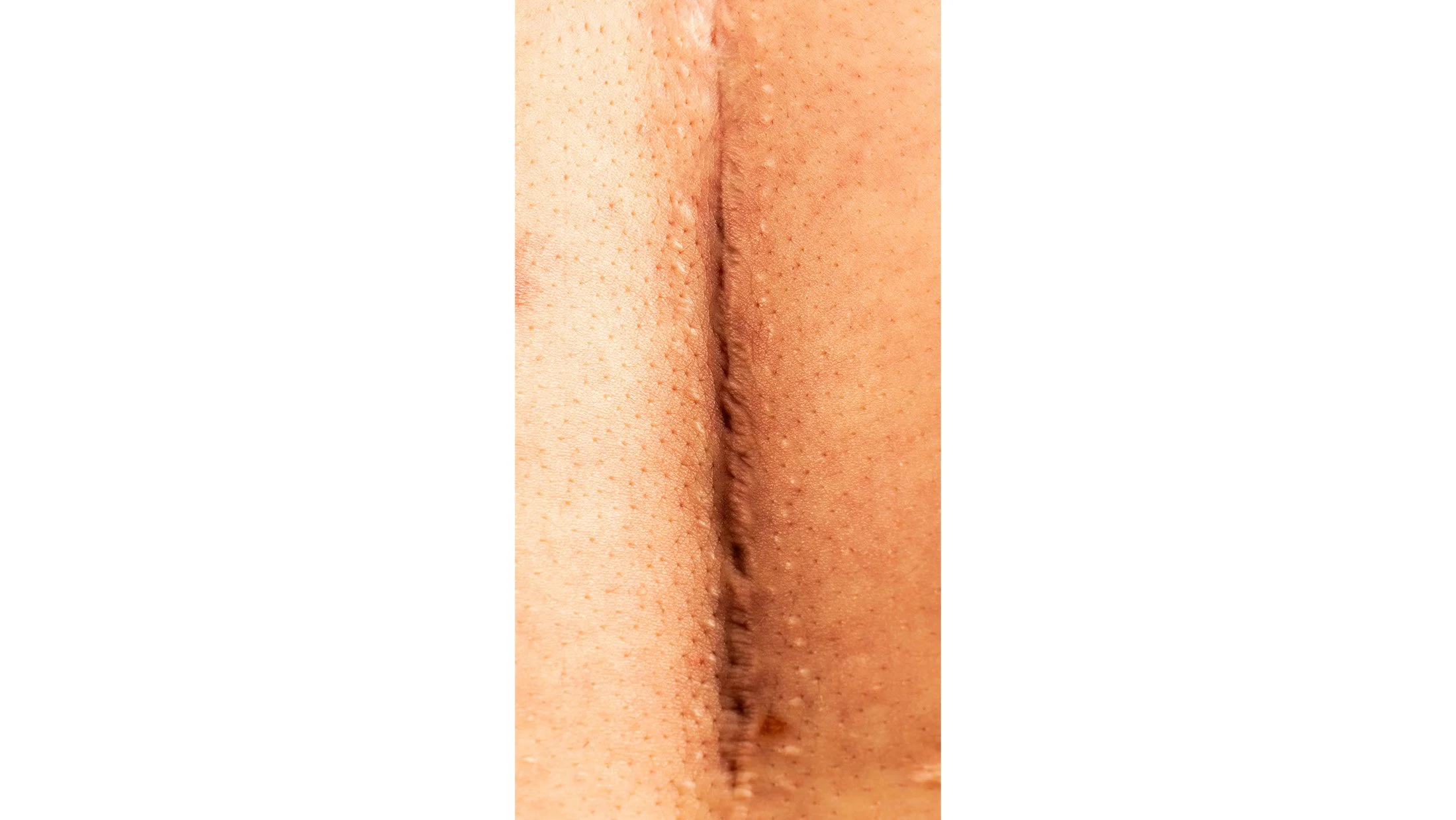 Macro Scar.