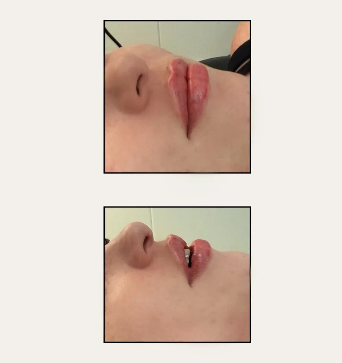 ☀️This client took advantage of the Full Syringe Summer Lip Promotion. ☀️👄 $445 reg. $550 

Can you believe we injected 1.5 syringes over the last 2 months? 

Soft, natural and lifted.

#lipfiller #brantfordlipfillers #brantfordbotox