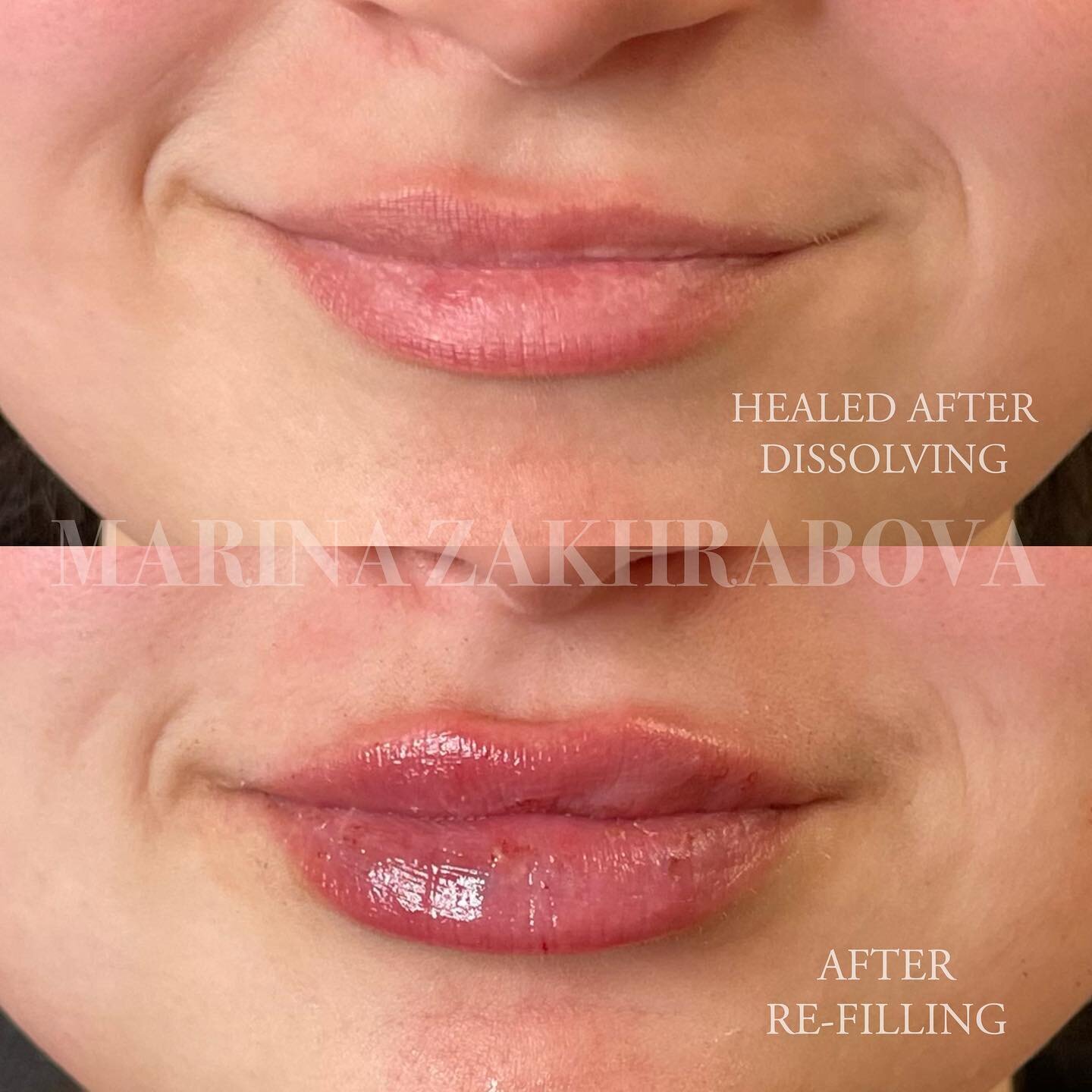 Took a page out of @jordonio.np&rsquo;s DISSOLVE✖RESOLVE book with these lips 📖📚💋

Initially, my patient came to see me for lip filler after having it previously done elsewhere. Migration was noted outside of the lip tissue, so we did one session 