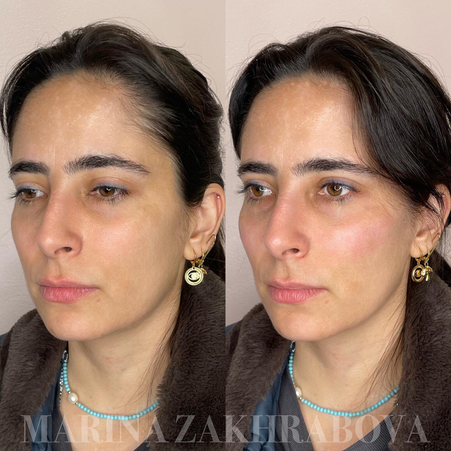 CHEEK FILLER with Juvederm Voluma 💉

As we age, our skin loses elasticity and volume, resulting in a sunken or hollow appearance, especially in areas like the midface. Cheek fillers can help to restore volume, giving the face a more youthful and ref