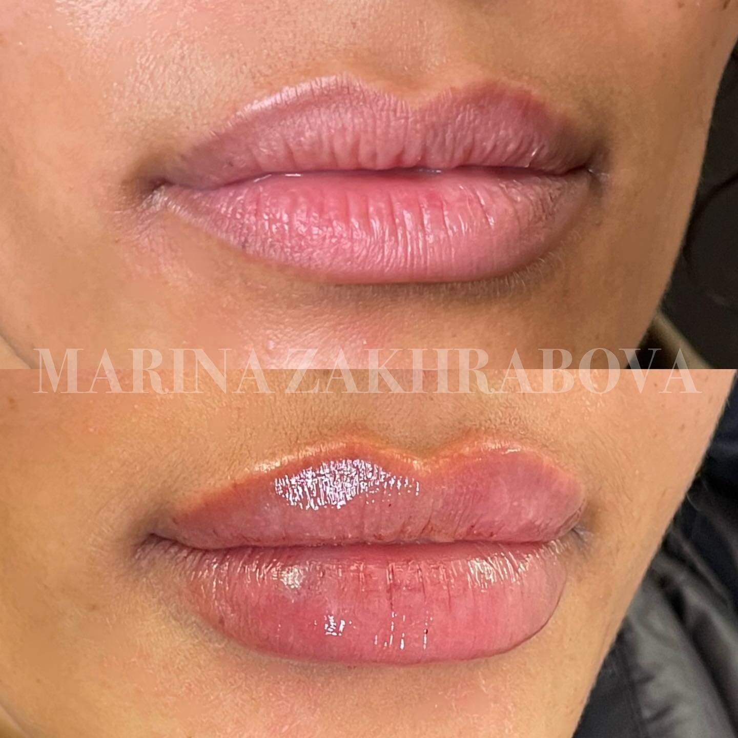 Adding hydration and definition with LIP FILLER 🫦💦

💉 Product: Restylane Kysse
⚖️ Amount: 1 mL
💵 Price: varies
📆 Longevity: up to 12 months
⏰ Appointment time: 30-45 minutes
❤️&zwj;🩹 Downtime: swelling and bruising will occur, please allow 2 we