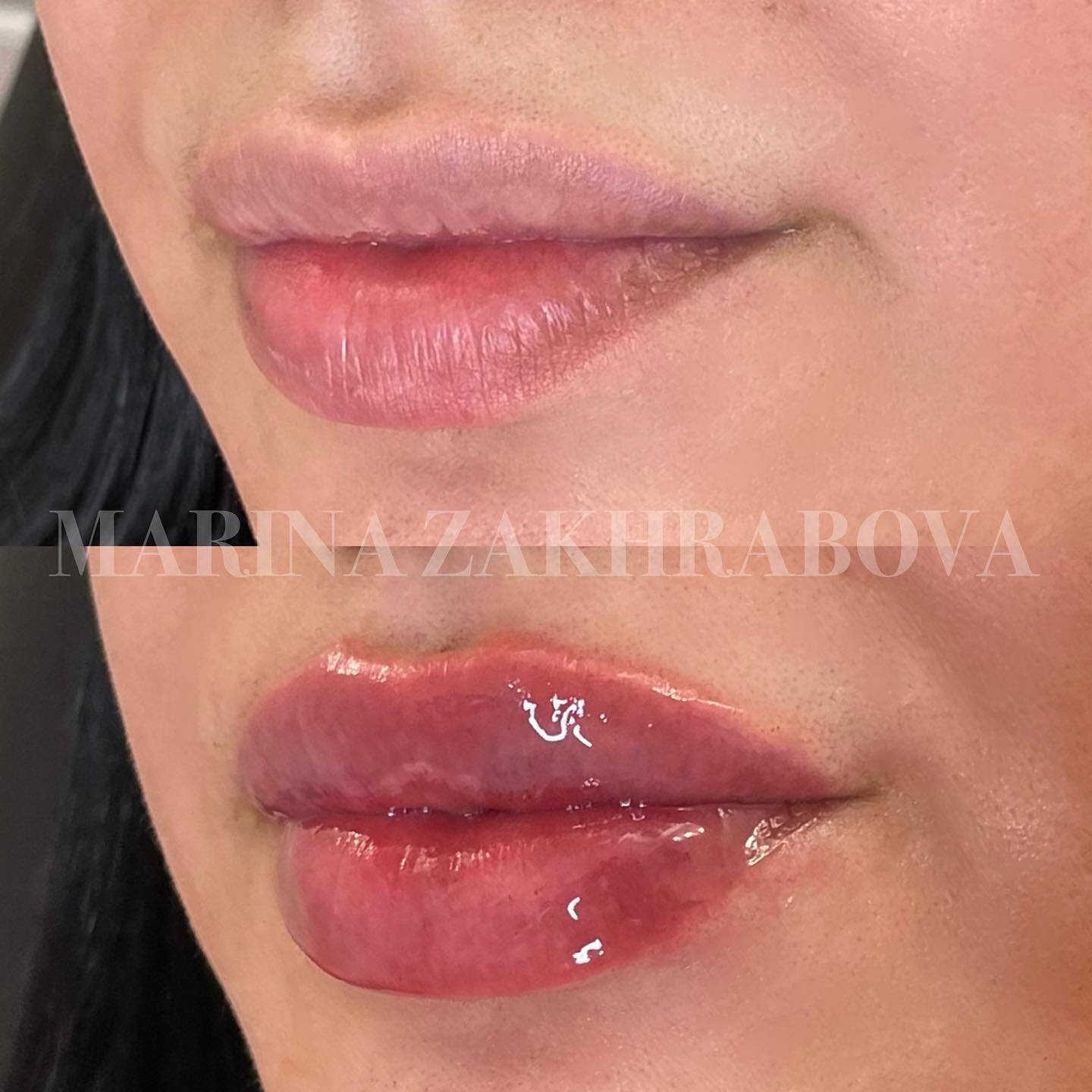 Adding volume in all the right places with LIP FILLER to create the perfect plump pout 💋

💉 Product: Restylane Kysse
⚖️ Amount: 0.5 mL
💵 Price: varies
📆 Longevity: up to 12 months
⏰ Appointment time: 30-45 minutes
❤️&zwj;🩹 Downtime: swelling and