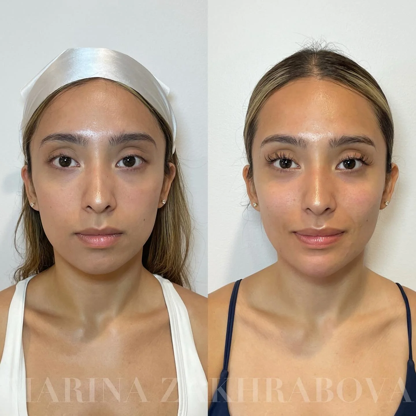Facial balancing isn&rsquo;t about changing how you look &mdash; it&rsquo;s about restoring proportion, harmony, and natural beauty through subtle enhancements. Think of it as contouring with injectables ✨

Areas treated:
&bull; midface
&bull; laugh 