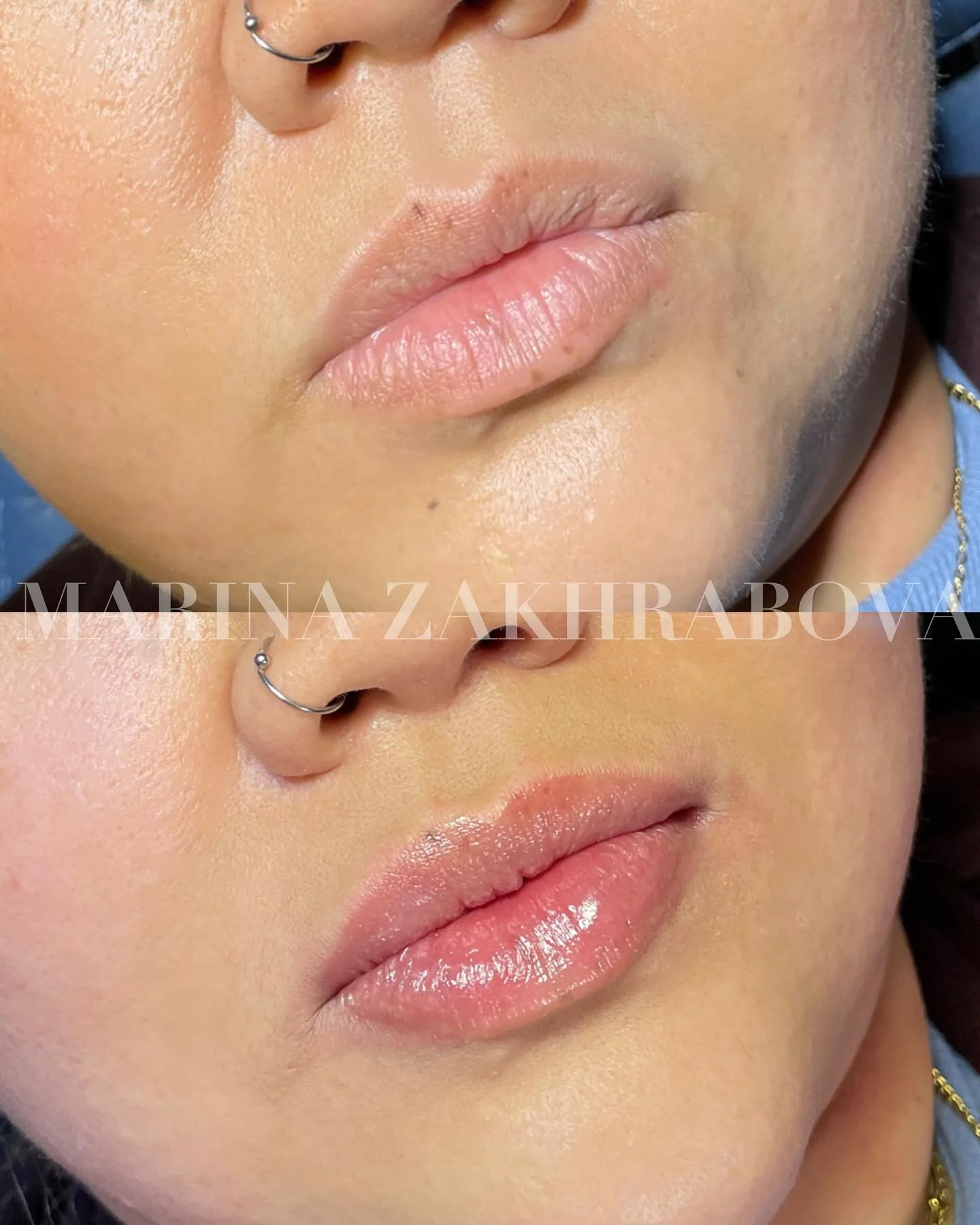 Advanced Technique, Natural Results 💋

These beautiful lips were treated using a microcannula technique to fill above and below the muscle &mdash; creating smooth, soft, and balanced volume while maintaining natural movement.

This approach was refi