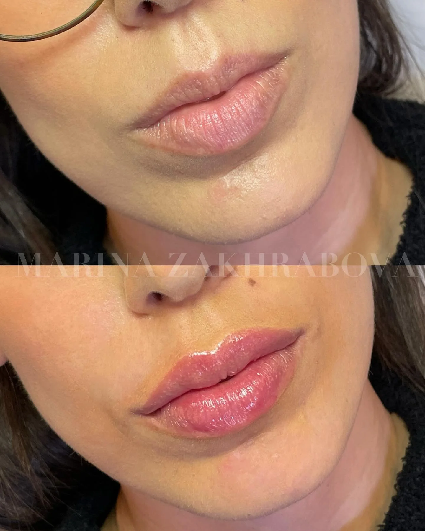 Swedish Lip Technique using microcannula 💋

Instead of chasing volume, this approach focuses on harmony and structure. By placing filler above and below the lip muscle, we:
&bull; Enhance natural shape
&bull; Improve upper/lower lip balance
&bull; C