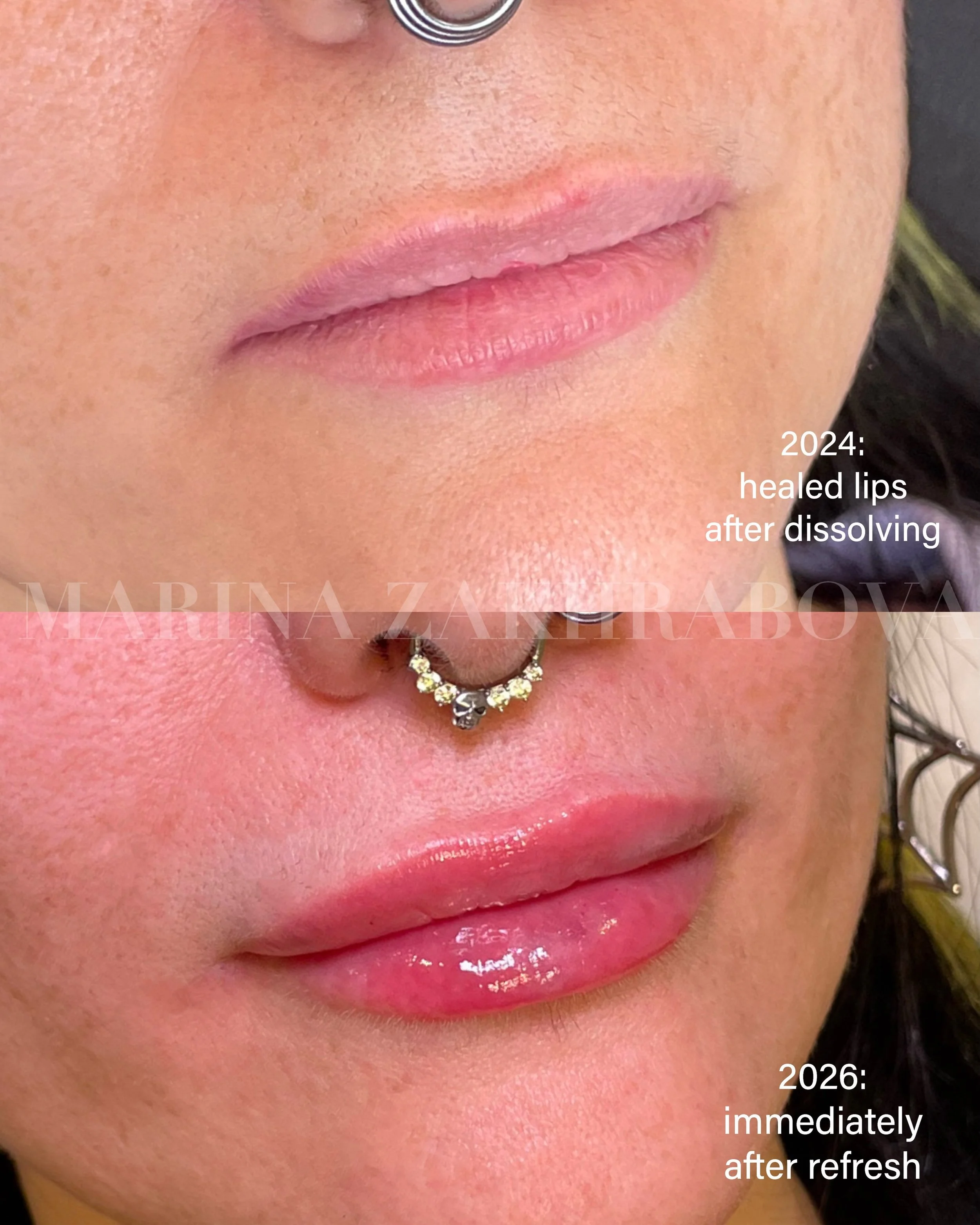 Two years. One plan.

These lips were dissolved, rebuilt over time, and most recently refreshed using the Swedish Lips cannula technique by @dr.rebecka.gardell.

I don&rsquo;t believe every appointment needs to dramatically change the lips. Sometimes