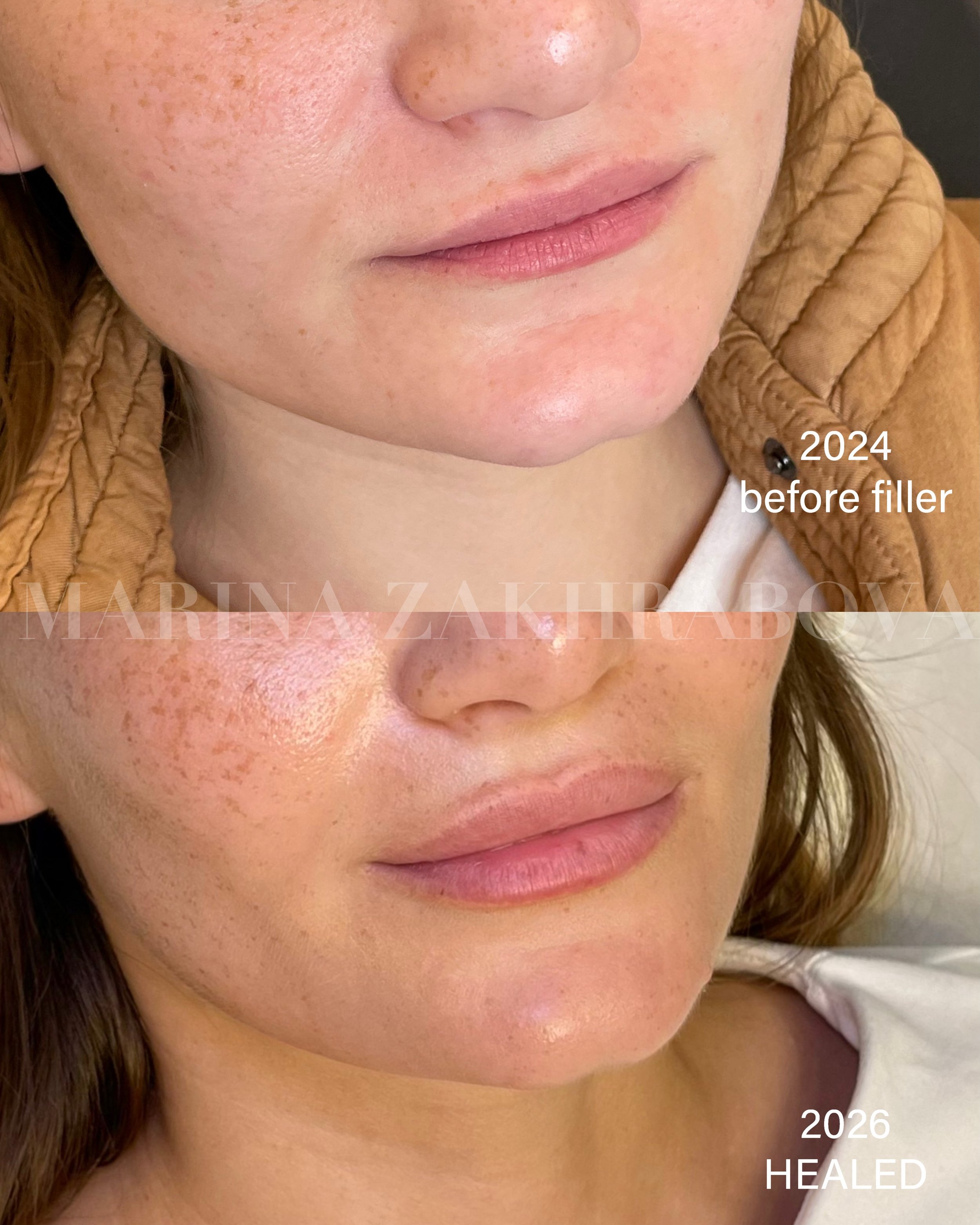 A little can go a long way 💋

This patient was first treated with 0.5 mL of lip filler in 2024. Two years later, we added another 0.5 mL to refresh her shape and definition while keeping the result soft and proportional to her features.

Lip filler 