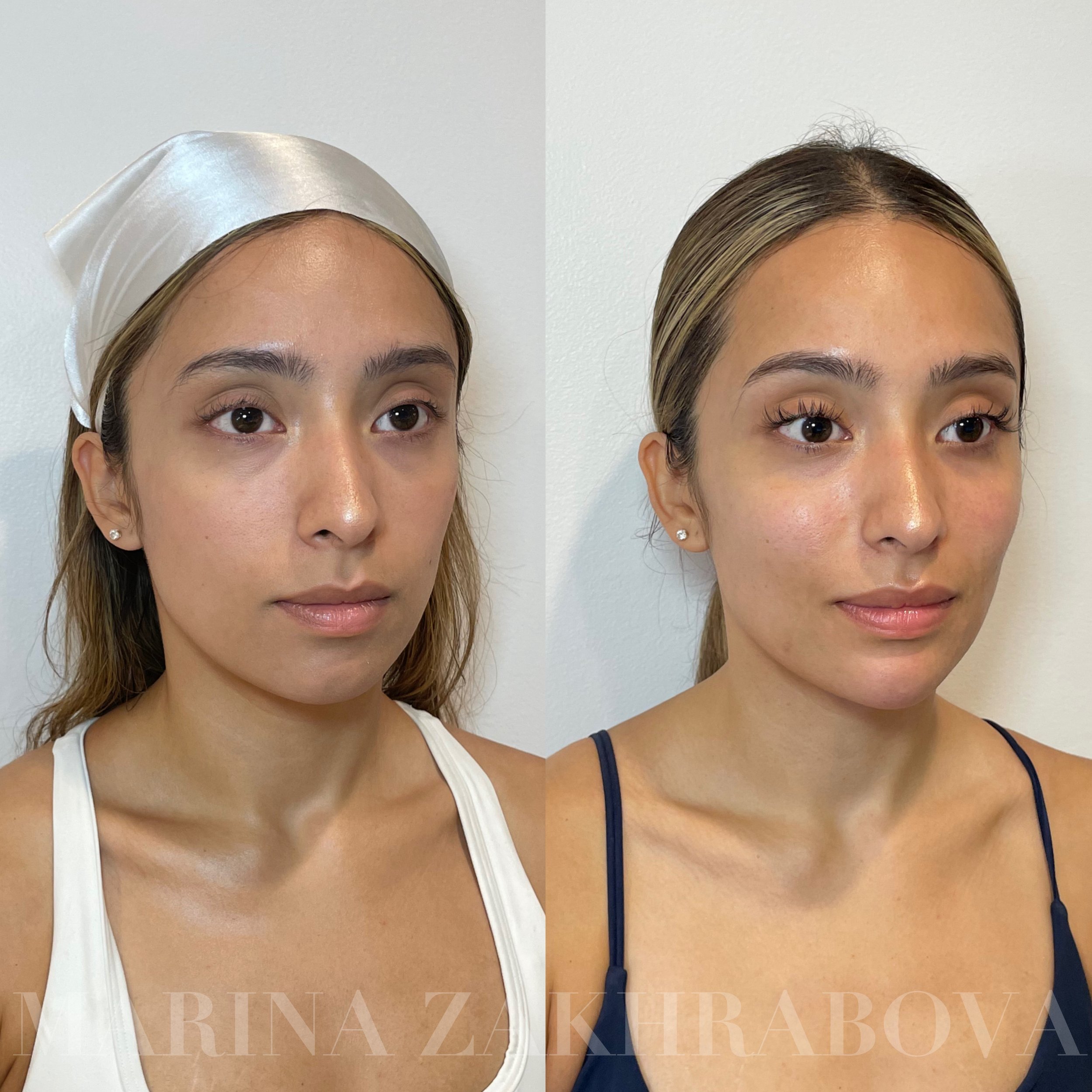 Before and HEALED midface, lips, and chin filler + lower face neurotoxin