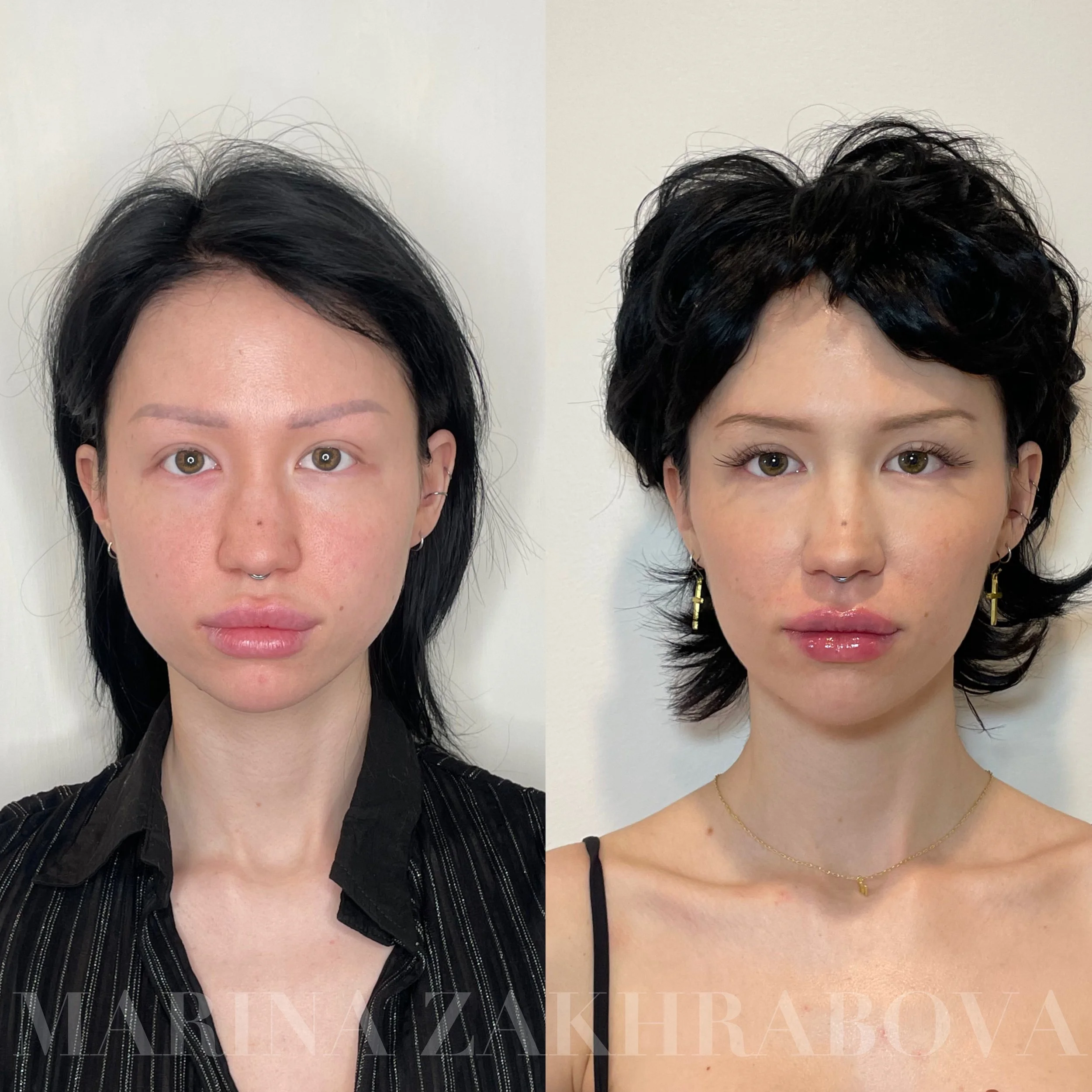 Before and HEALED midface and chin filler + nose and masseter Botox with FRESH lips after dissolve x resolve