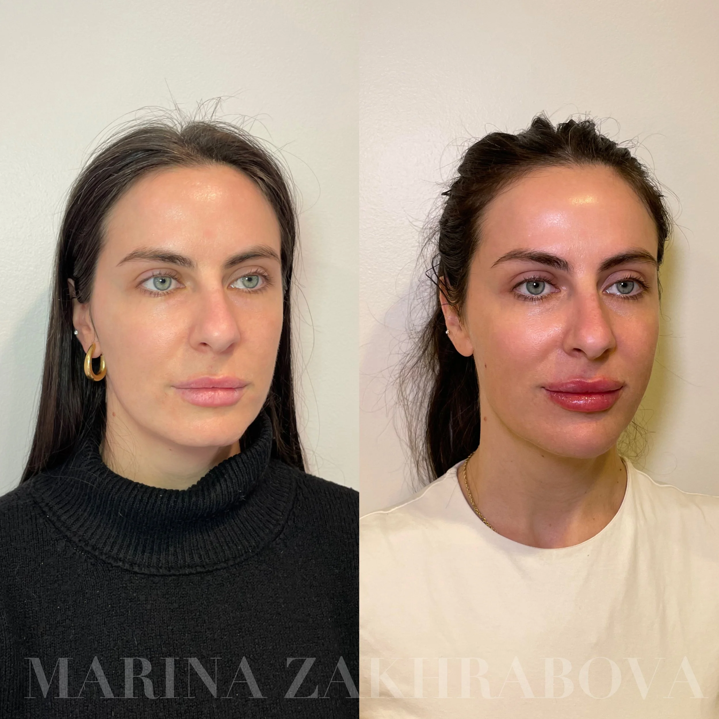 Before and HEALED Sculptra (2 session) + chin filler + full face neurotoxin with FRESH lip filler after dissolve x resolve