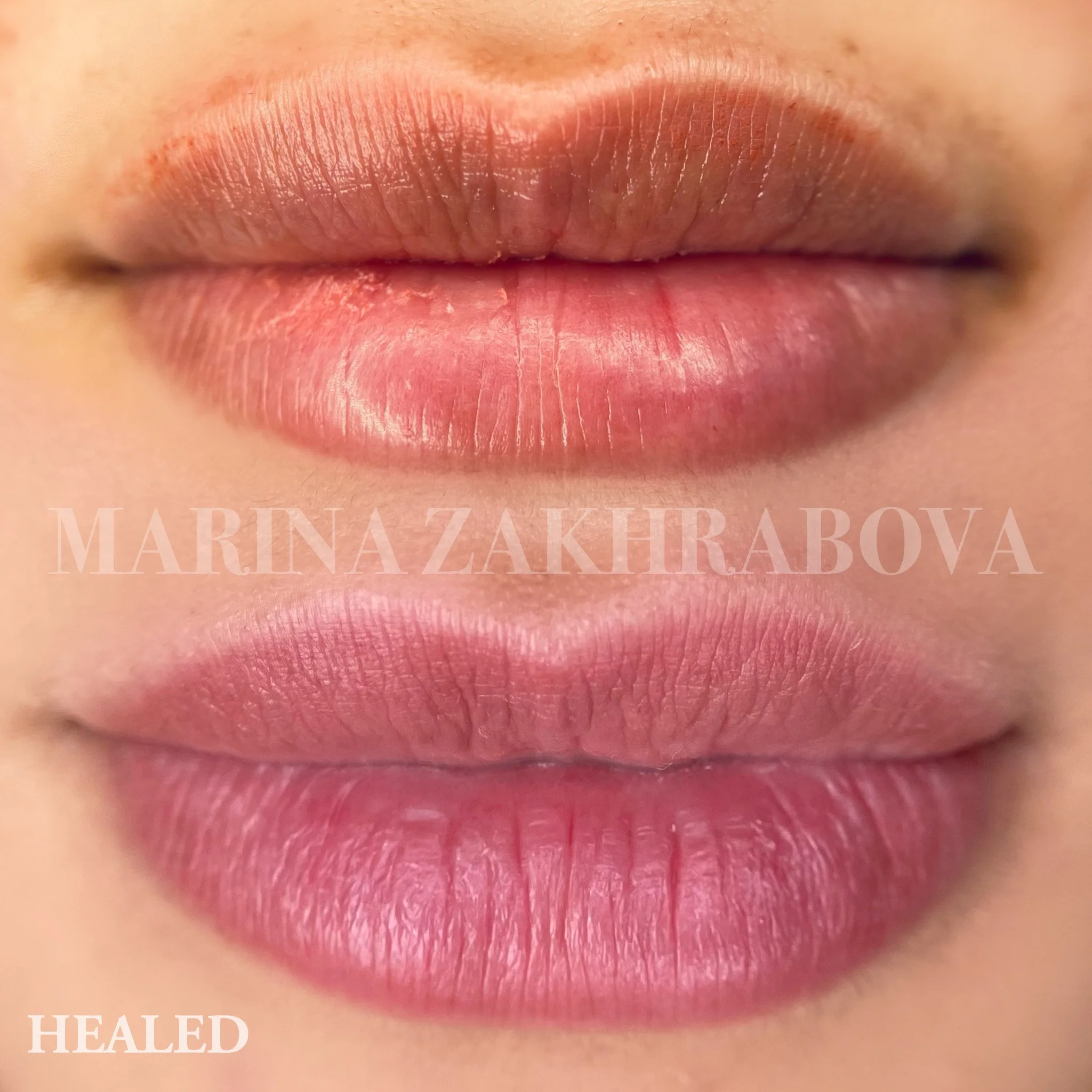 before and HEALED lip neutralization