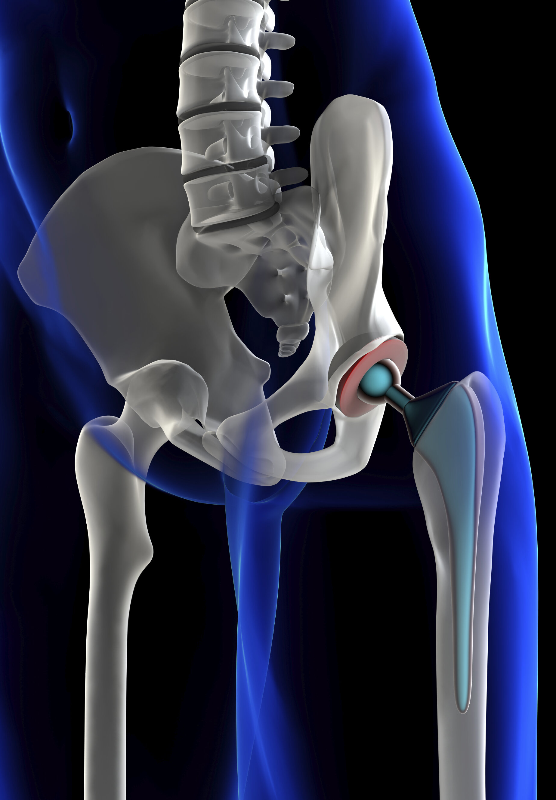 Замена сустава шейки бедра. Эндопротезирование бедренной кости. Имплант бедренной кости. Имплант бедренной кости человека. Эндопротезирование тазобедренного сустава.