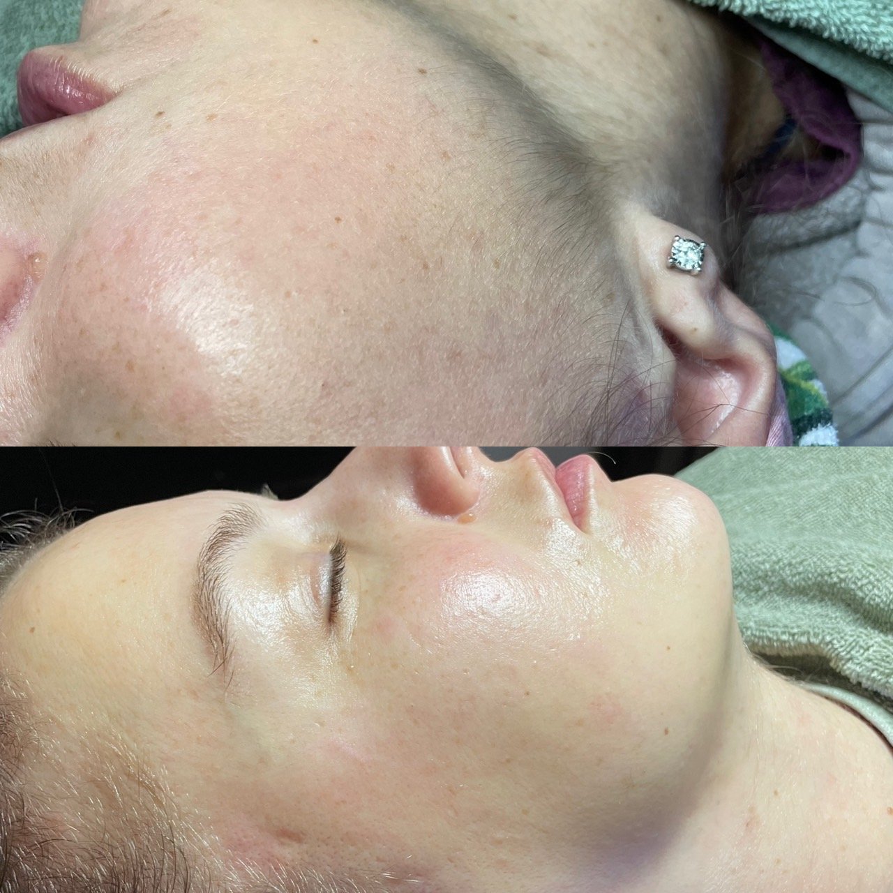 Before &amp; After Hydrafacial Treatment with Dermaplane