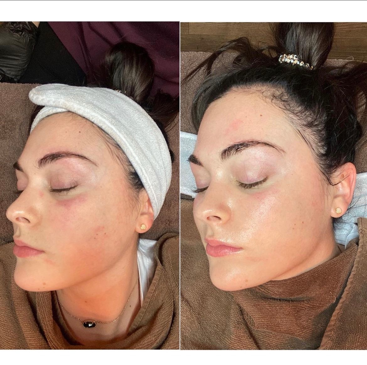 Hydrafacial Treatment Before &amp; After