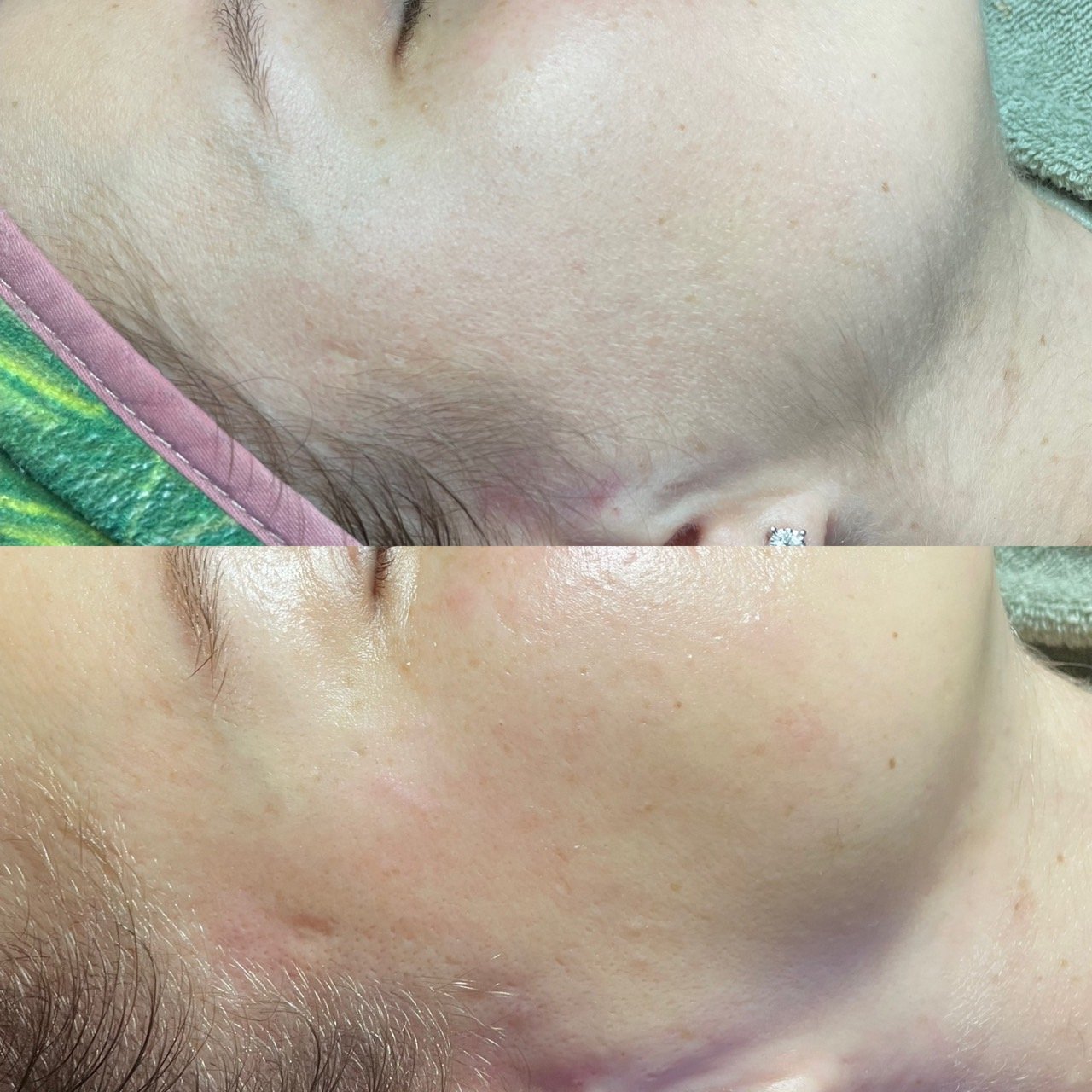 Before &amp; After Hydrafacial Treatment with Dermaplane