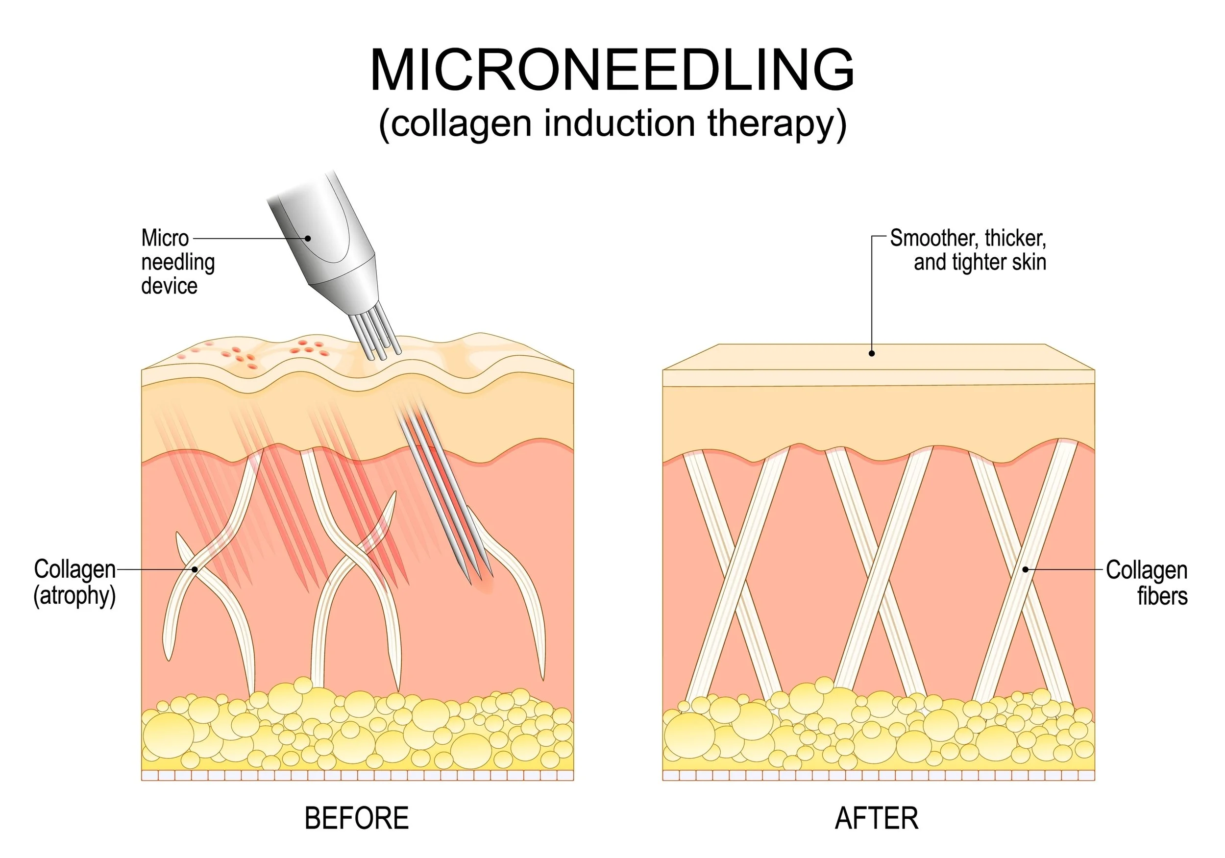 Discover Microneedling Benefits For Youthful Skin