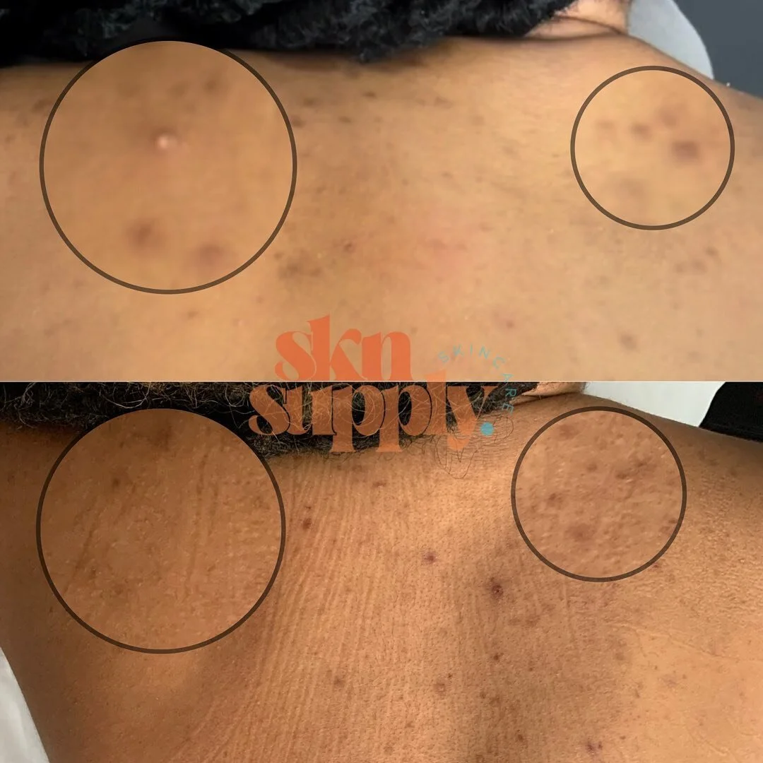 Back facials/peels for the summer and sleeveless tops. 🧡🍊