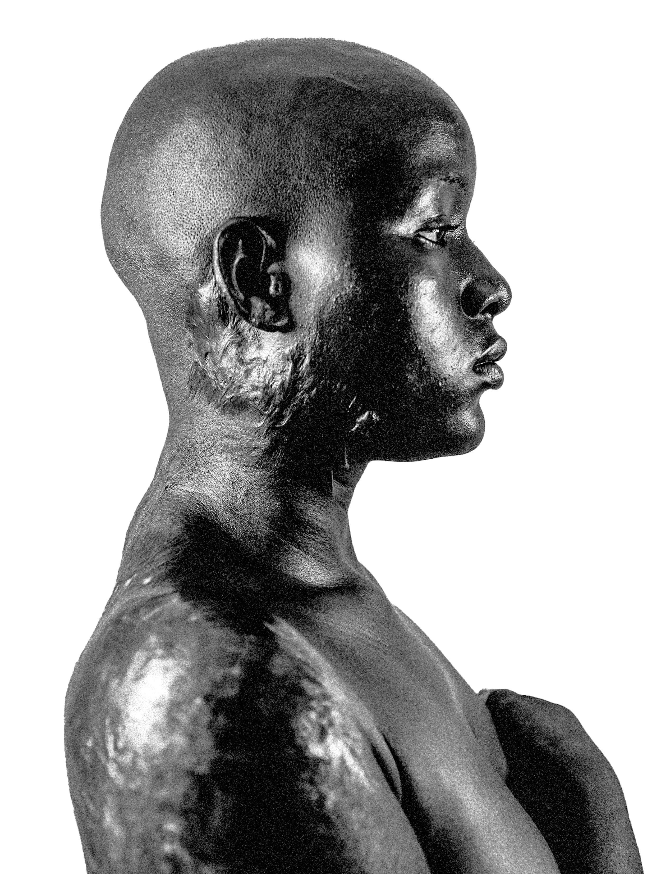 Black and white side profile photograph of a bald woman with textured skin and a serious expression against a white background.