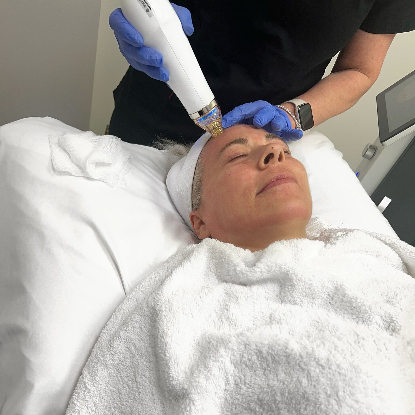 Secret RF combines microneedling and radiofrequency to tighten skin, reduce wrinkles, and enhance texture. 

This minimally invasive treatment stimulates collagen production, offering a versatile solution for various skin concerns without the need fo