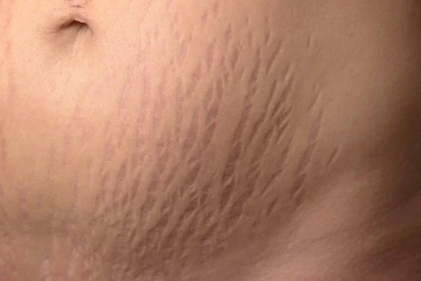 RF Microneedling with PRP for Stretch Marks
