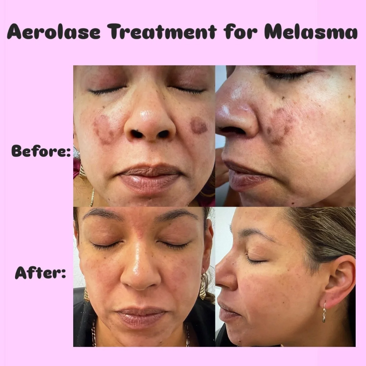 Melasma doesn&rsquo;t have to be permanent ✨
This before &amp; after shows what Aerolase can do&mdash;clearer, brighter, more even skin without harsh downtime. Call today to schedule a free consultation 847-990-0510. 

#Aerolase #Melasma #AerolaseRes