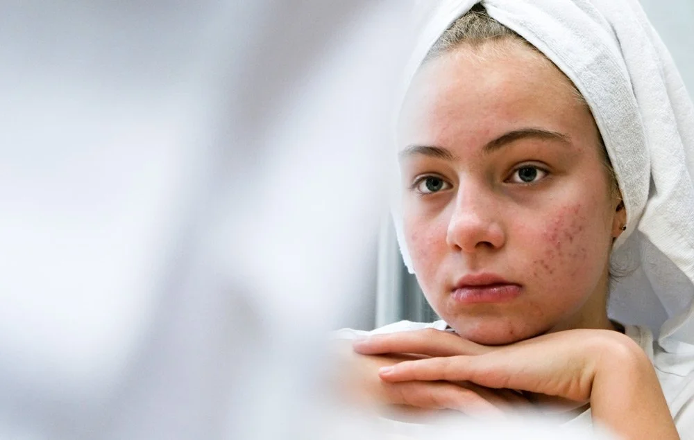 Lamprobe Facial Vein Treatment — Cordial Medical Spa
