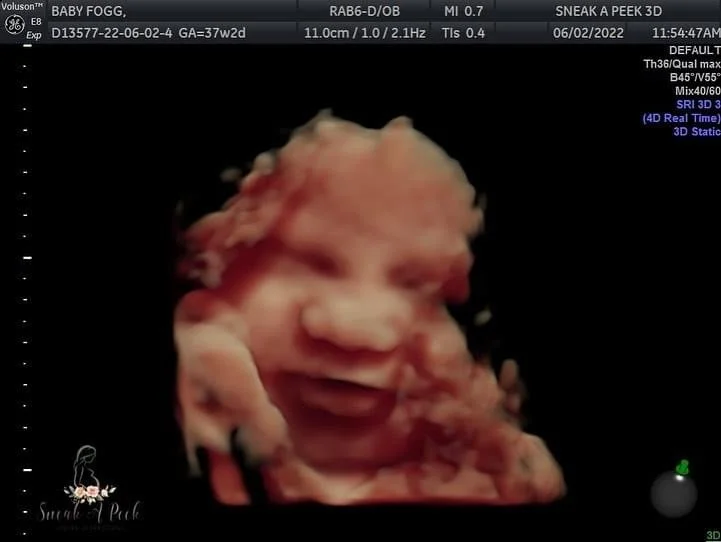 Sneak A Peek 3d Ultrasound