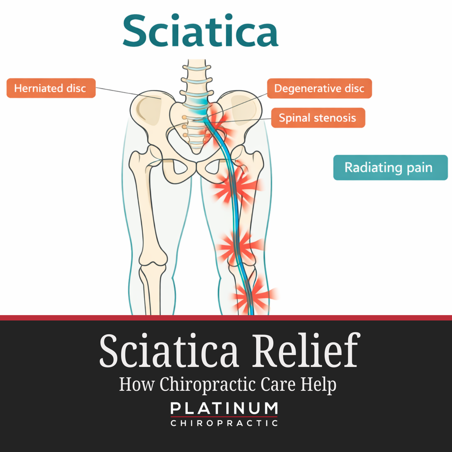 Sciatica Treatment: Chiropractic Care for Sciatica Pain Relief in Auckland