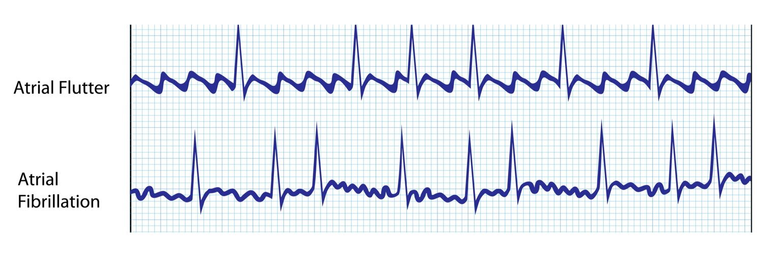 Difference between a flutter and afib - filegulu