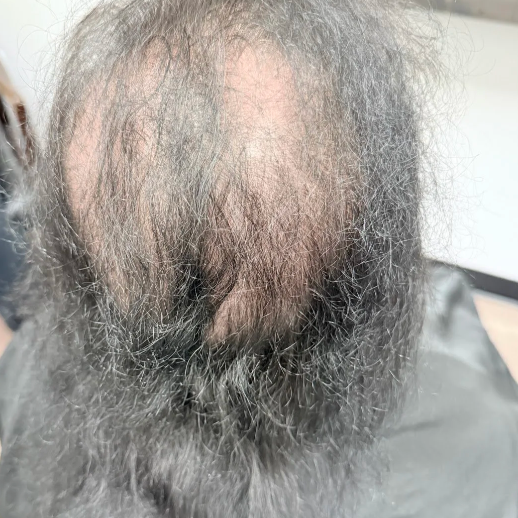 mesh integration hair loss solution San Diego