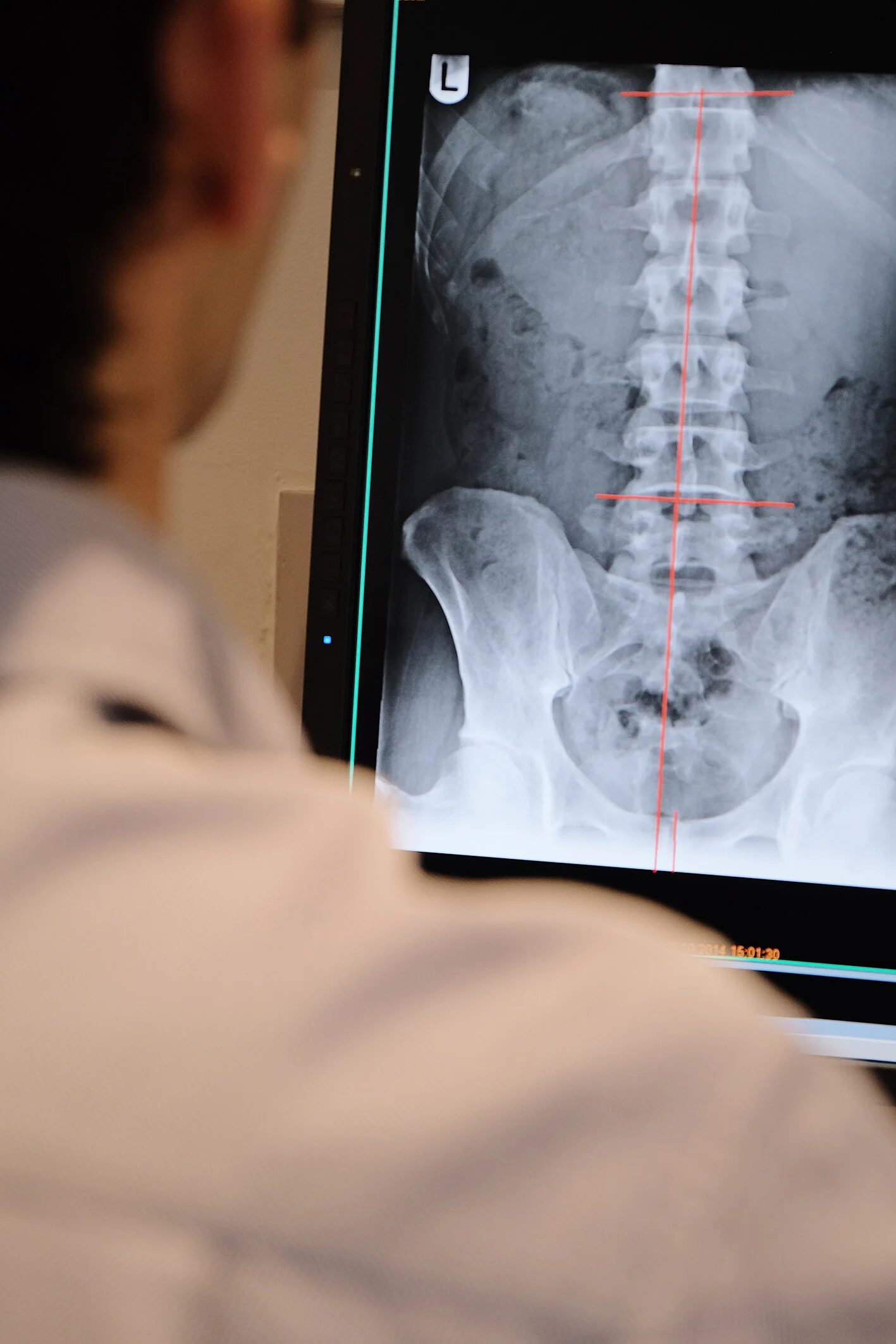 Battersea Wandsworth Chiropractors SW11 1TH Xrays disc sciatica.jpg