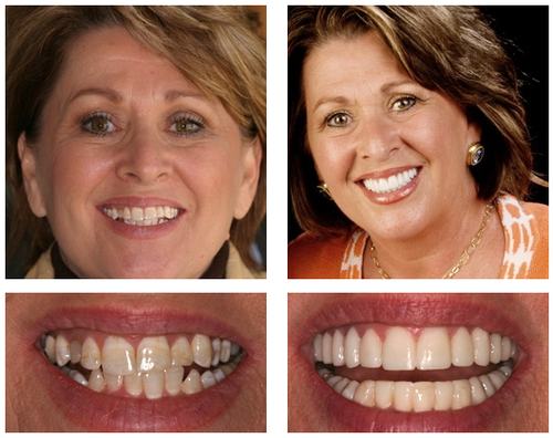 Smile+treatment,+teeth+whitening,+amarillo+cosmetic+dentist.png