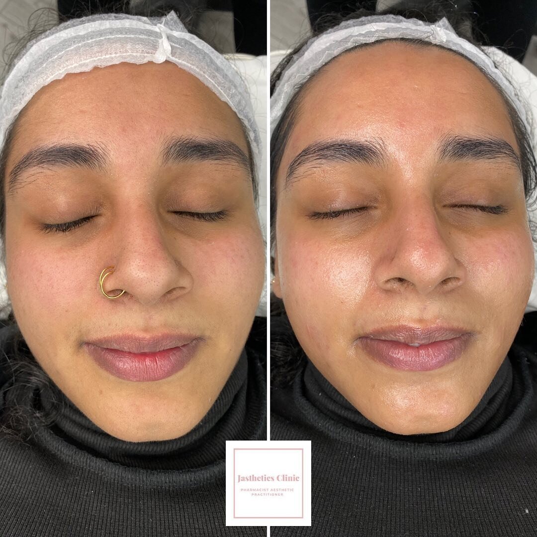 Do you feel you need a deep exfoliating treatment? Why not book in for Dermaplane and Microdermabrasion 🔪. This treatment gets rid of peach fuzz, dirt and oils and dead skin cells to reveal a lovely glow along with silky smooth skin 🙌🏽. Treatments